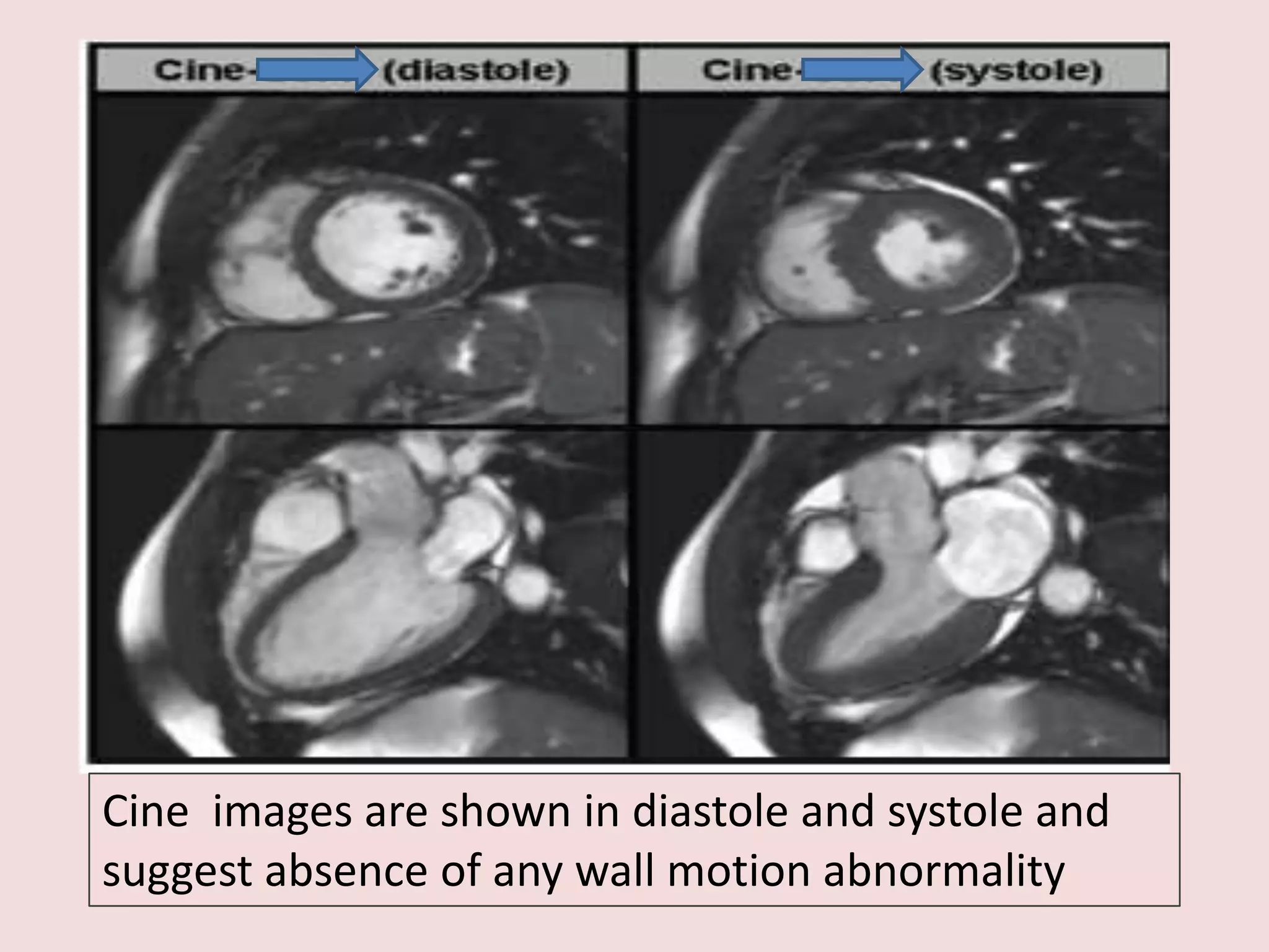 Cine images are shown in diastole and systole and
suggest absence of any wall motion abnormality

 