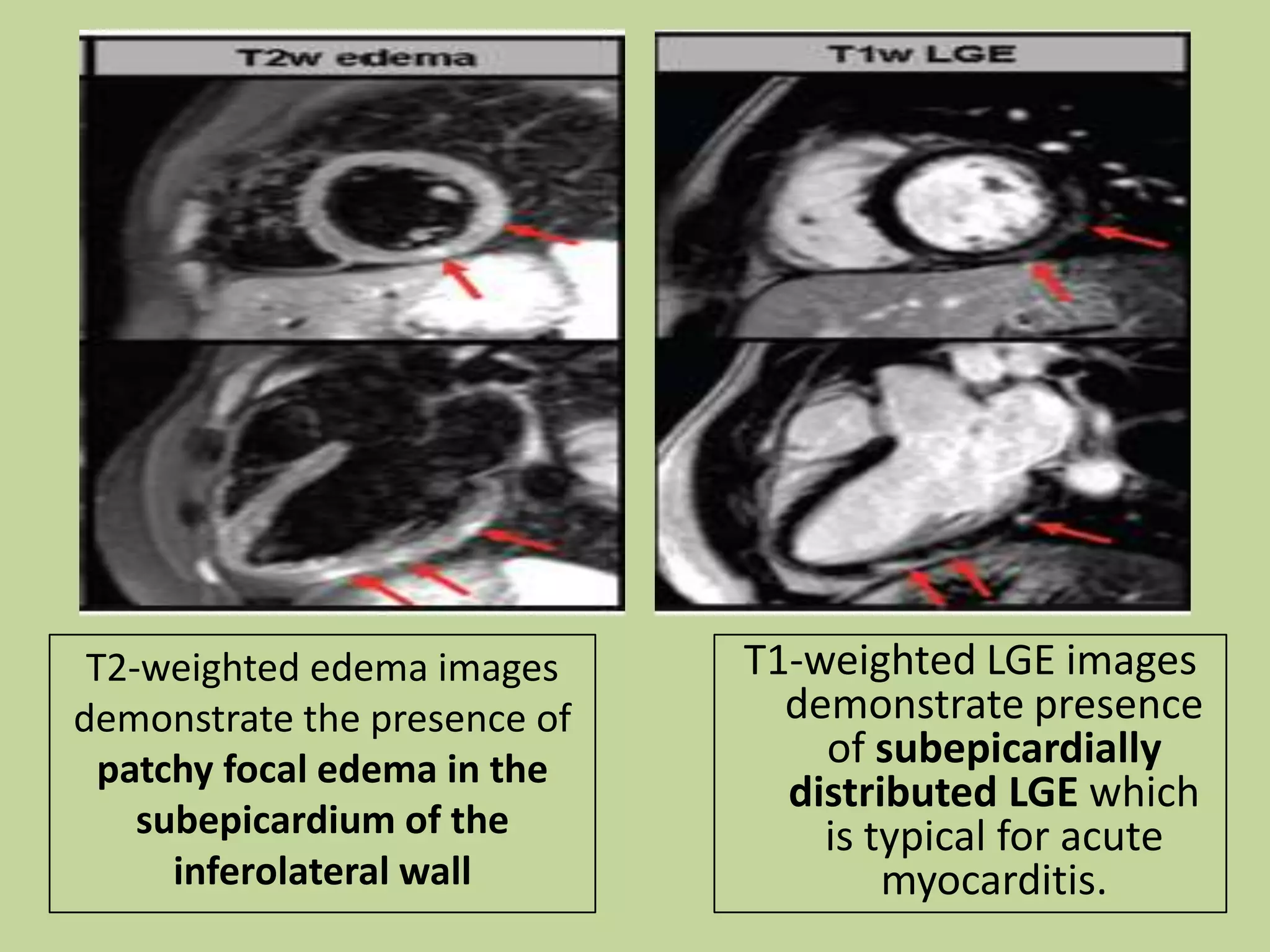 T2-weighted edema images
demonstrate the presence of
patchy focal edema in the
subepicardium of the
inferolateral wall

T1-weighted LGE images
demonstrate presence
of subepicardially
distributed LGE which
is typical for acute
myocarditis.

 