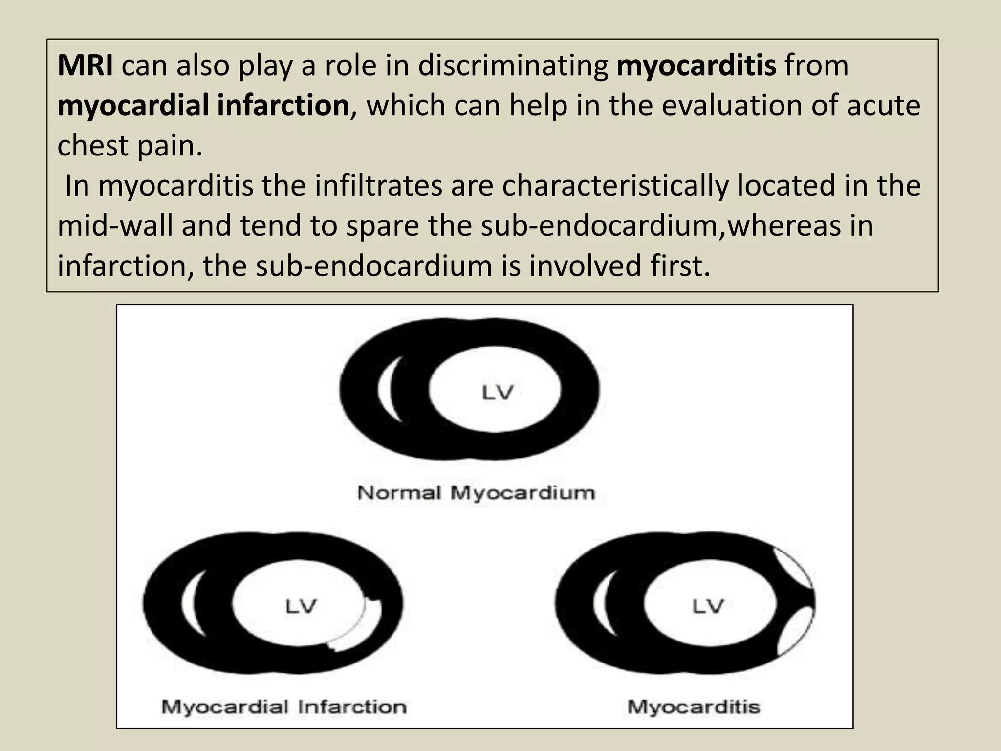 MRI can also play a role in discriminating myocarditis from
myocardial infarction, which can help in the evaluation of acute
chest pain.
In myocarditis the infiltrates are characteristically located in the
mid-wall and tend to spare the sub-endocardium,whereas in
infarction, the sub-endocardium is involved first.

 
