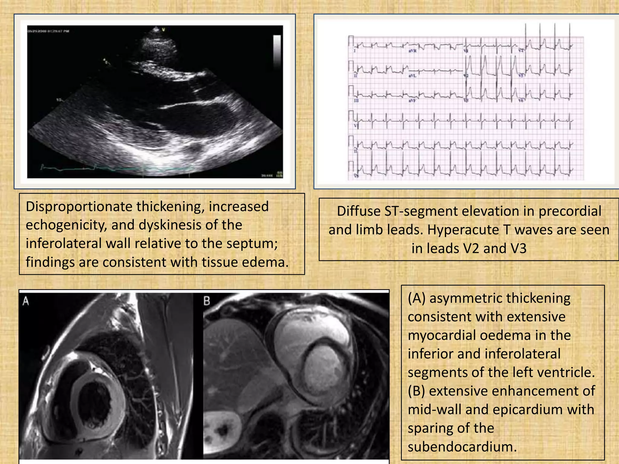 Disproportionate thickening, increased
echogenicity, and dyskinesis of the
inferolateral wall relative to the septum;
findings are consistent with tissue edema.

Diffuse ST-segment elevation in precordial
and limb leads. Hyperacute T waves are seen
in leads V2 and V3
(A) asymmetric thickening
consistent with extensive
myocardial oedema in the
inferior and inferolateral
segments of the left ventricle.
(B) extensive enhancement of
mid-wall and epicardium with
sparing of the
subendocardium.

 