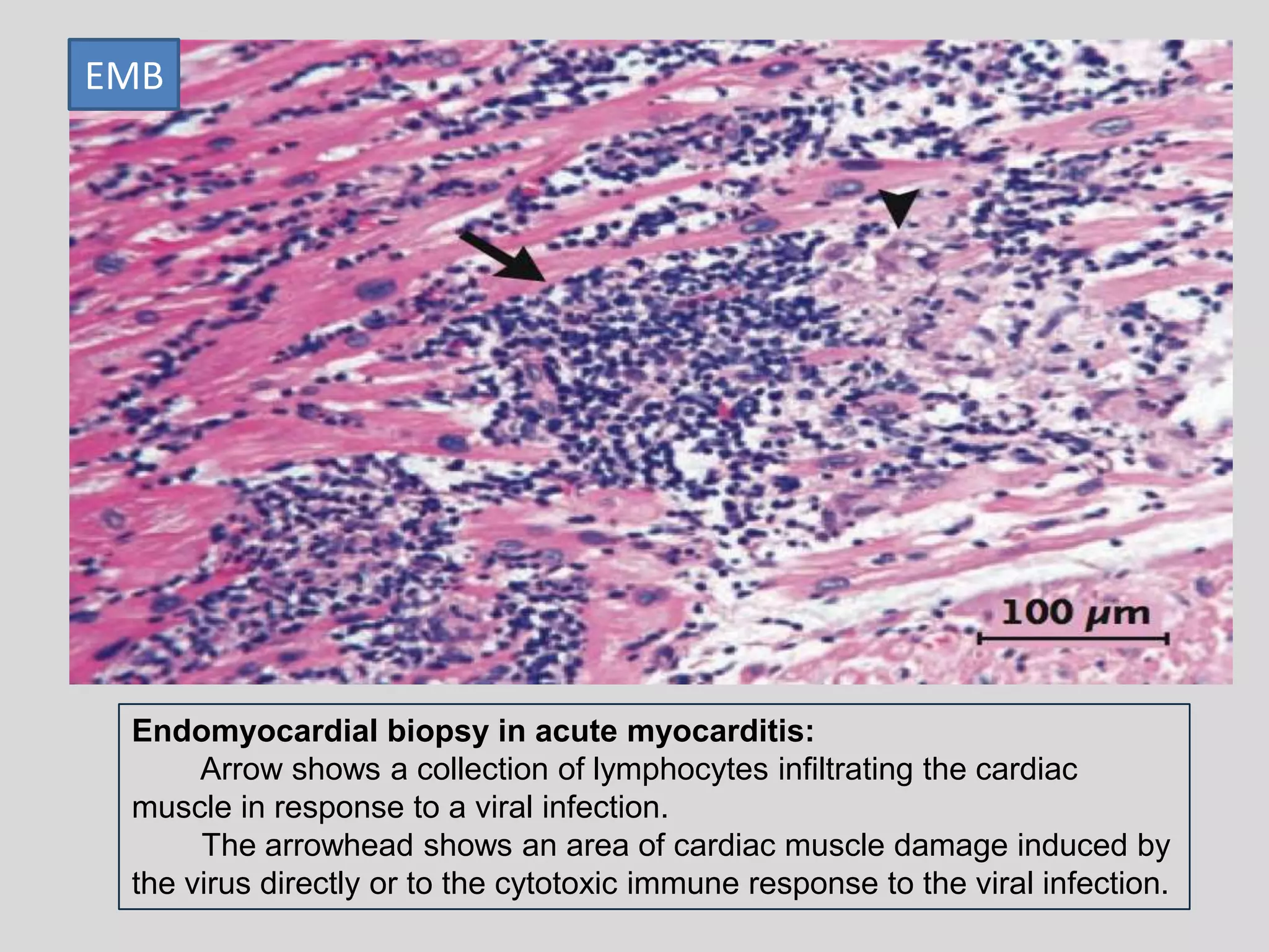 EMB

Endomyocardial biopsy in acute myocarditis:
Arrow shows a collection of lymphocytes infiltrating the cardiac
muscle in response to a viral infection.
The arrowhead shows an area of cardiac muscle damage induced by
the virus directly or to the cytotoxic immune response to the viral infection.

 
