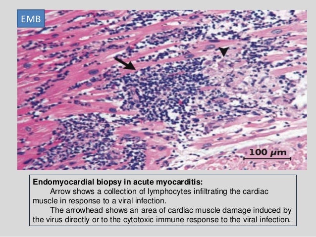 Myocarditis