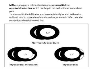 MRI can also play a role in discriminating myocarditis from
myocardial infarction, which can help in the evaluation of acute chest
pain.
In myocarditis the infiltrates are characteristically located in the mid-
wall and tend to spare the sub-endocardium,whereas in infarction, the
sub-endocardium is involved first.
 