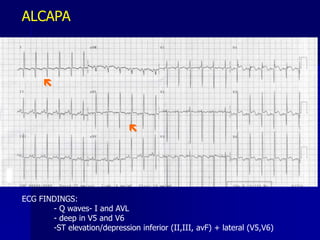 

ECG FINDINGS:
- Q waves- I and AVL
- deep in V5 and V6
-ST elevation/depression inferior (II,III, avF) + lateral (V5,V6)
ALCAPA
 