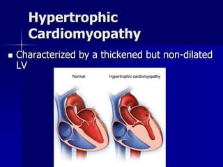 Hypertrophic
Cardiomyopathy
 Characterized by a thickened but non-dilated
LV
 