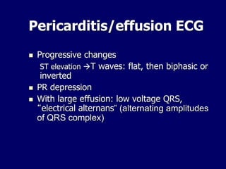 Pericarditis/effusion ECG
 Progressive changes
ST elevation T waves: flat, then biphasic or
inverted
 PR depression
 With large effusion: low voltage QRS,
“electrical alternans” (alternating amplitudes
of QRS complex)
 