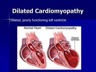 Dilated Cardiomyopathy
Dilated, poorly functioning left ventricle
 