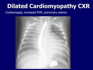 Dilated Cardiomyopathy CXR
Cardiomegaly, increased PVM, pulmonary edema
 