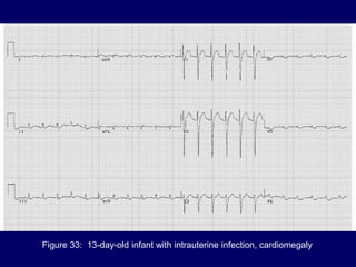 Figure 33: 13-day-old infant with intrauterine infection, cardiomegaly
 