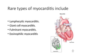 myocarditaaaaaaaaaaaaaaaaaaaaaaaaaais (1).pptx