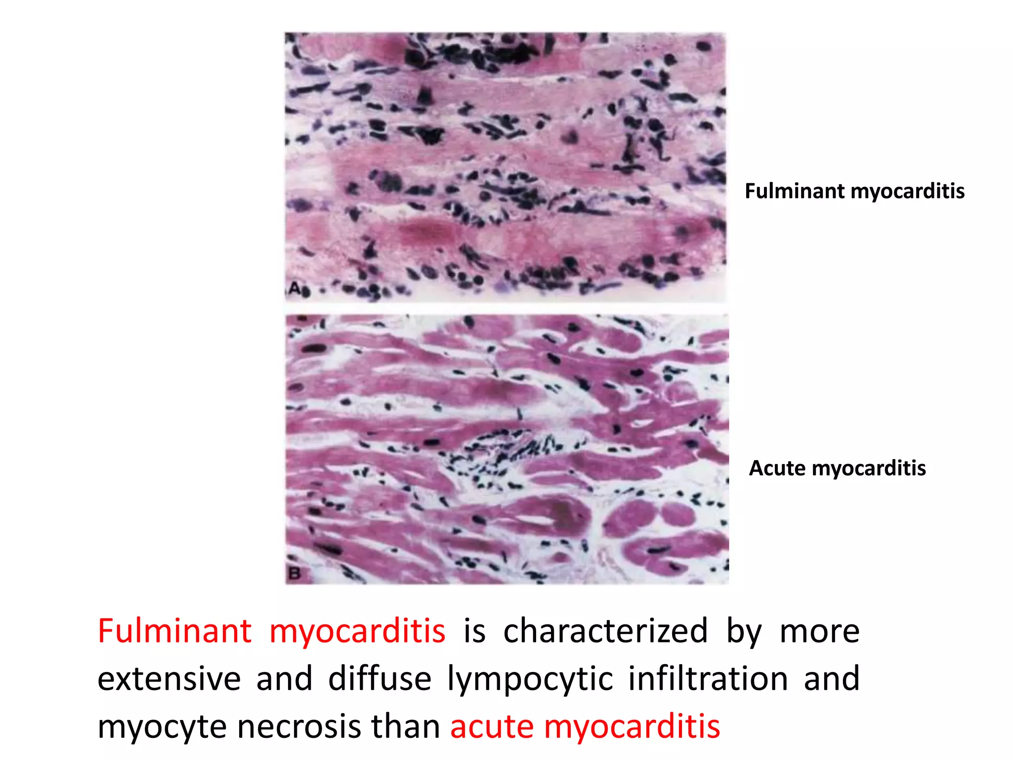 Fulminant myocarditis
Acute myocarditis
Fulminant myocarditis is characterized by more
extensive and diffuse lympocytic infiltration and
myocyte necrosis than acute myocarditis
 