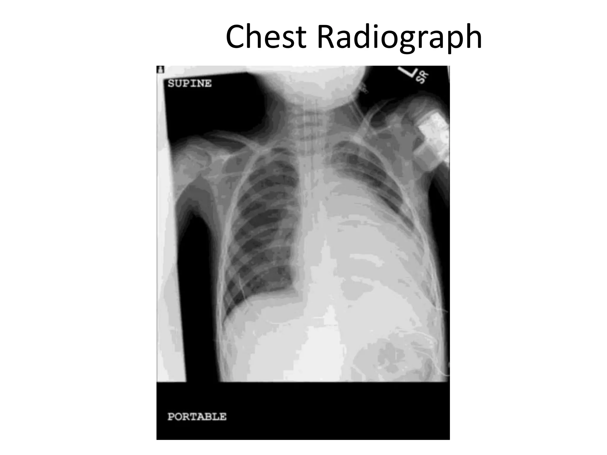 Chest Radiograph
 