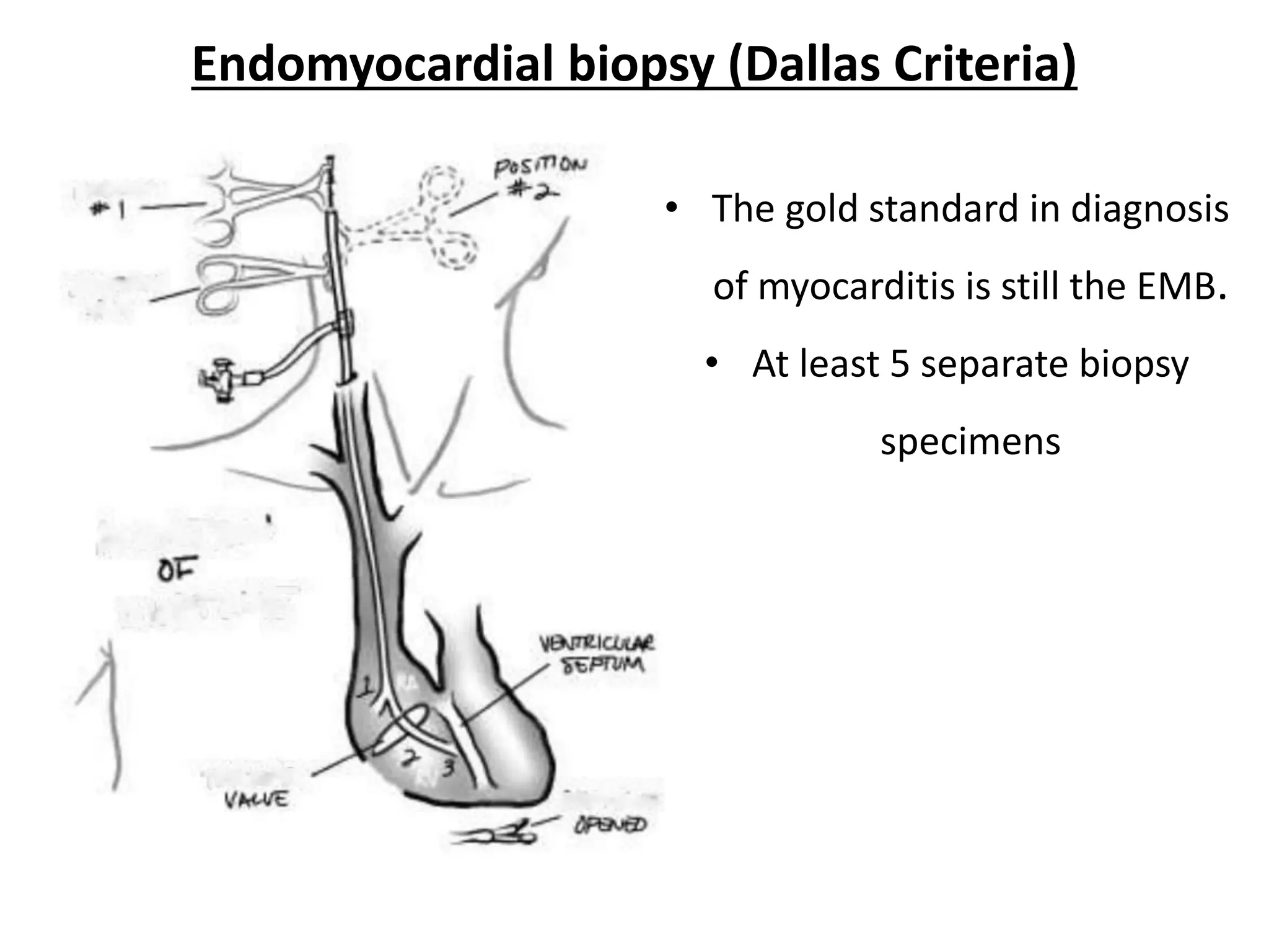 Endomyocardial biopsy (Dallas Criteria)
• The gold standard in diagnosis
of myocarditis is still the EMB.
• At least 5 separate biopsy
specimens
 