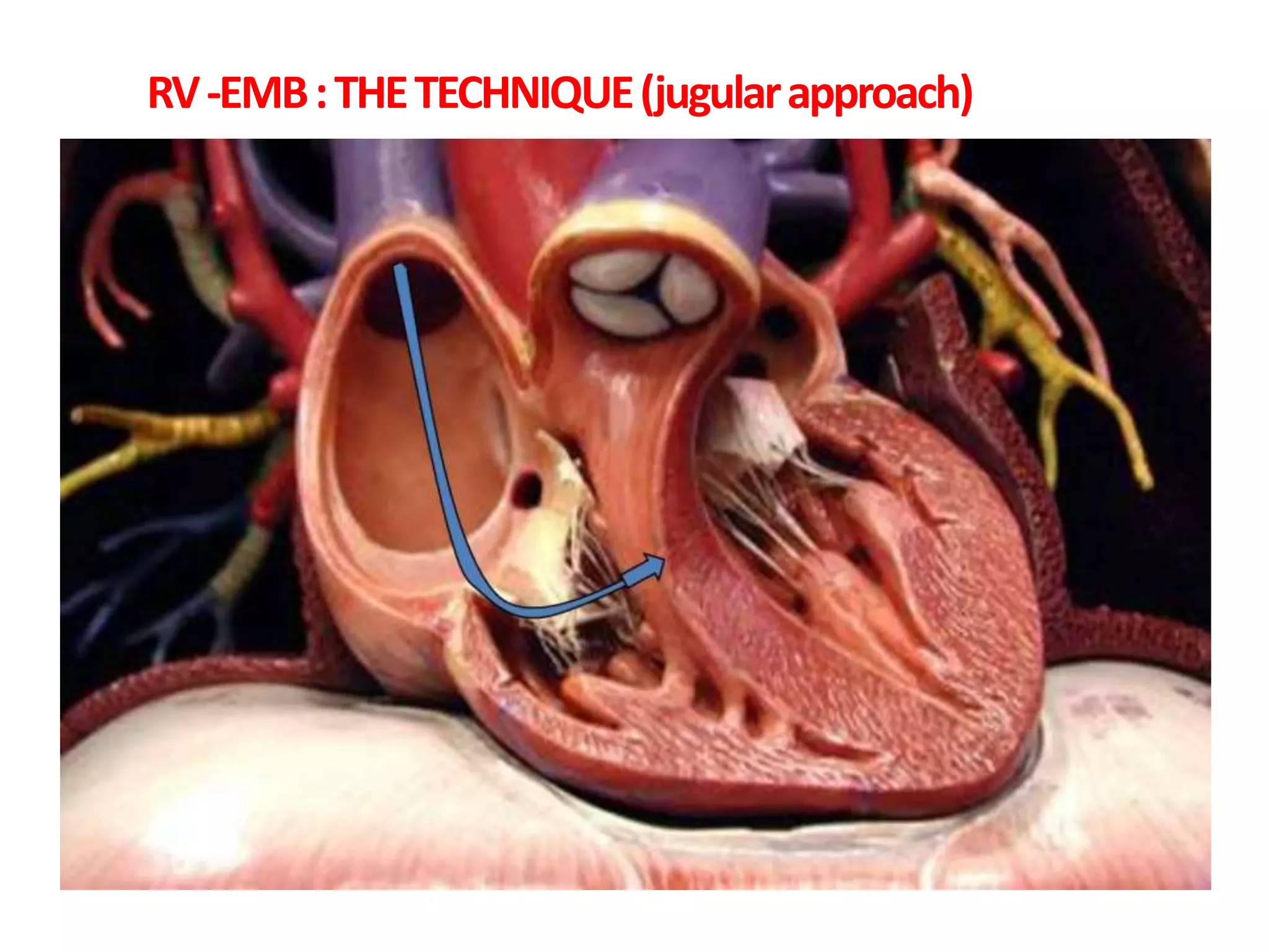 RV-EMB:THETECHNIQUE(jugularapproach)
 