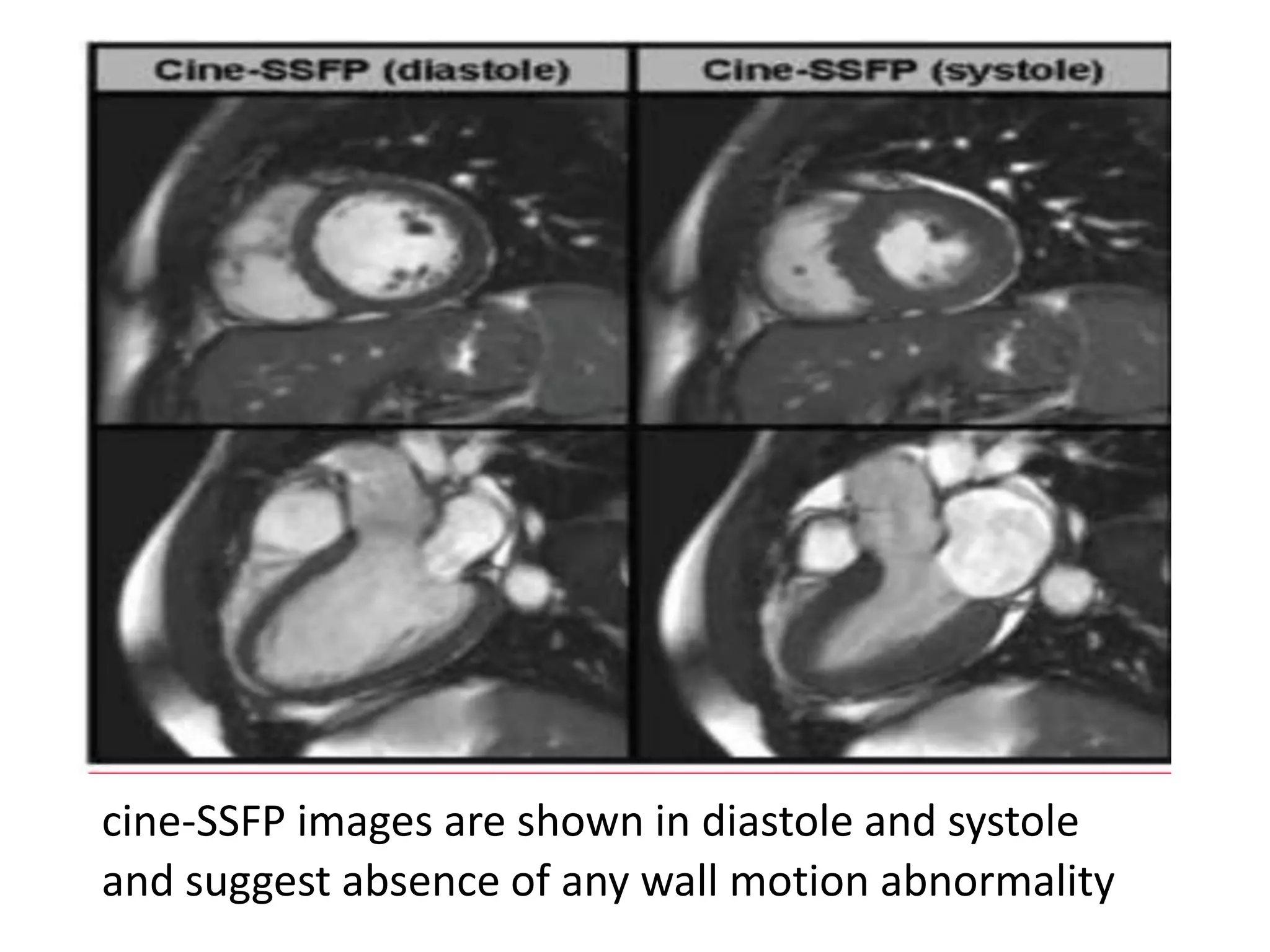 cine-SSFP images are shown in diastole and systole
and suggest absence of any wall motion abnormality
 