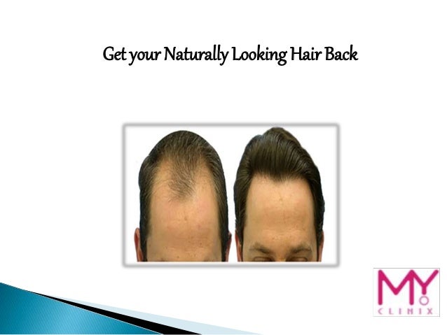 Get Your Naturally Looking Hair Back