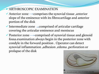  ARTHROSCOPIC EXAMINATION
 Anterior zone comprises the synovial tissue ,anterior
slope of the eminence with its fibrocartilage and anterior
portion of the disk
 Intermediate zone comprised of articular cartilage
covering the articular eminence and meniscus
 Posterior zone comprised of synovial tissue and glenoid
fossa.examination always begin in the posterior zone with
condyle in the forward position . Operator can detect
synovial inflammation ,adhesion ,edema ,perforation or
prolapse of the disk
 