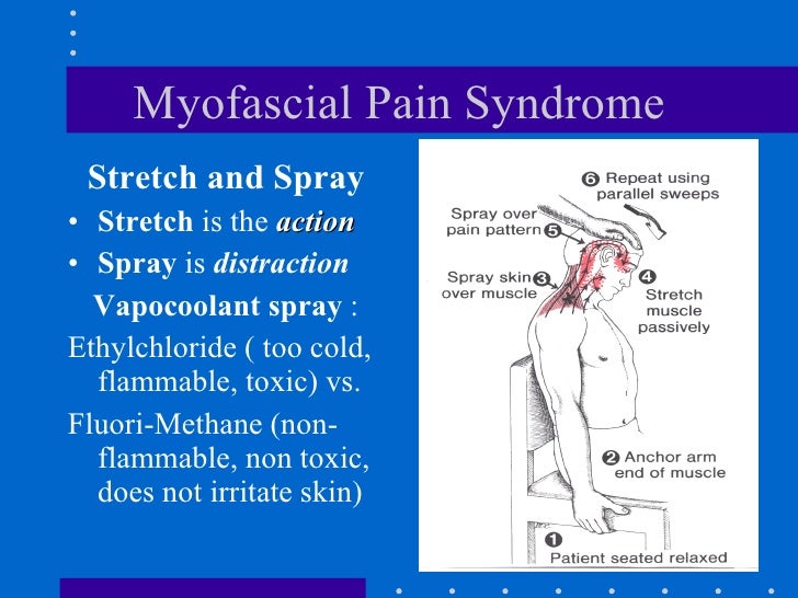 Myofascial Pain Syndrome