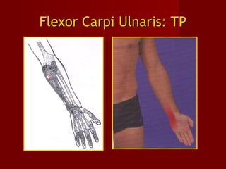 Flexor Carpi Ulnaris: TPFlexor Carpi Ulnaris: TP
 
