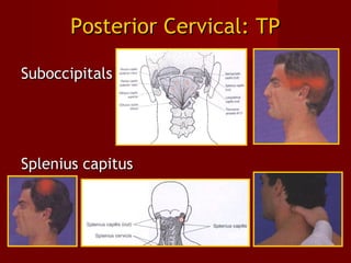 Posterior Cervical: TPPosterior Cervical: TP
SuboccipitalsSuboccipitals
Splenius capitusSplenius capitus
 