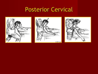 Posterior CervicalPosterior Cervical
 