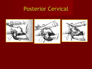 Posterior CervicalPosterior Cervical
 