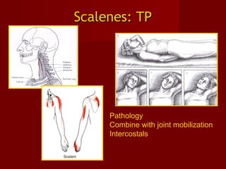 Scalenes: TPScalenes: TP
Pathology
Combine with joint mobilization
Intercostals
 