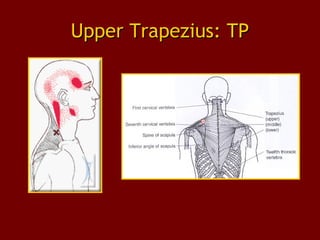 Upper Trapezius: TPUpper Trapezius: TP
 
