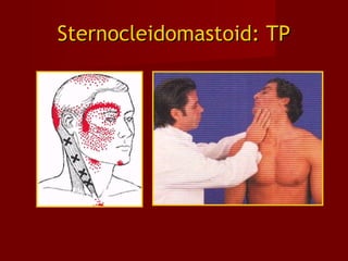 Sternocleidomastoid: TPSternocleidomastoid: TP
 