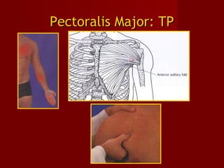 Pectoralis Major: TPPectoralis Major: TP
 