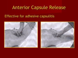 Anterior Capsule ReleaseAnterior Capsule Release
Effective for adhesive capsulitisEffective for adhesive capsulitis
 