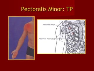 Pectoralis Minor: TPPectoralis Minor: TP
 