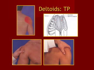 Deltoids: TPDeltoids: TP
 