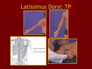Latissimus Dorsi: TPLatissimus Dorsi: TP
 