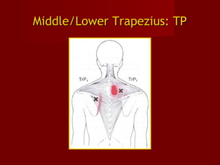 Middle/Lower Trapezius: TPMiddle/Lower Trapezius: TP
 