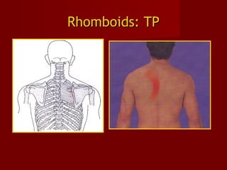 Rhomboids: TPRhomboids: TP
 