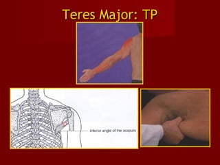 Teres Major: TPTeres Major: TP
 