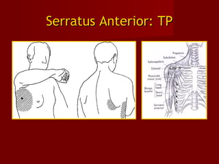 Serratus Anterior: TPSerratus Anterior: TP
 