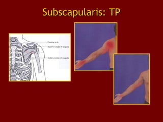 Subscapularis: TPSubscapularis: TP
 