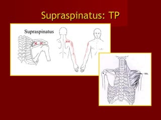 Supraspinatus: TPSupraspinatus: TP
 