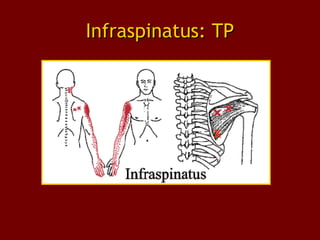 Infraspinatus: TPInfraspinatus: TP
X
 