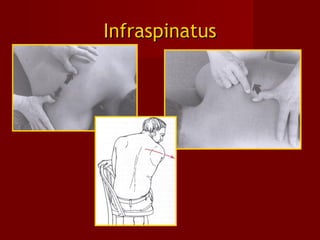 InfraspinatusInfraspinatus
 