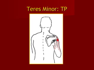 Teres Minor: TPTeres Minor: TP
 