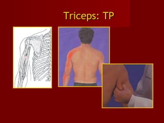 Triceps: TPTriceps: TP
 