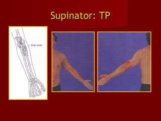 Supinator: TPSupinator: TP
 