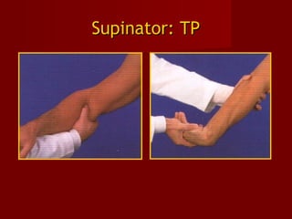 Supinator: TPSupinator: TP
 