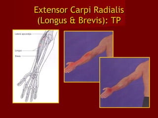 Extensor Carpi RadialisExtensor Carpi Radialis
(Longus & Brevis): TP(Longus & Brevis): TP
 