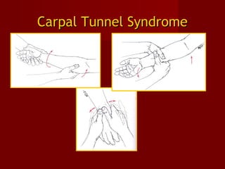 Carpal Tunnel SyndromeCarpal Tunnel Syndrome
 