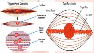 MYOFASCIAL TRIGGER POINTS / manual therapy for trigger points release ...