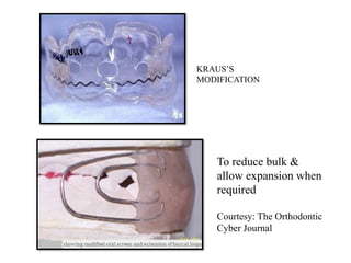 KRAUS’S
MODIFICATION
To reduce bulk &
allow expansion when
required
Courtesy: The Orthodontic
Cyber Journal
 